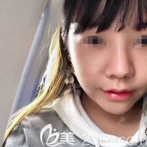 自体耳软骨+硅胶隆鼻术后半个月效果