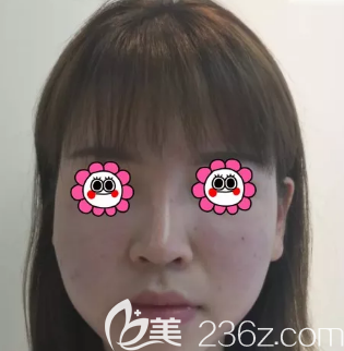 吸脂术前照片 吸脂术前照片