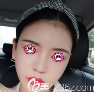 我是3月在淄博美冠臣做了面部吸脂手术，姐妹们可以参考一下哦