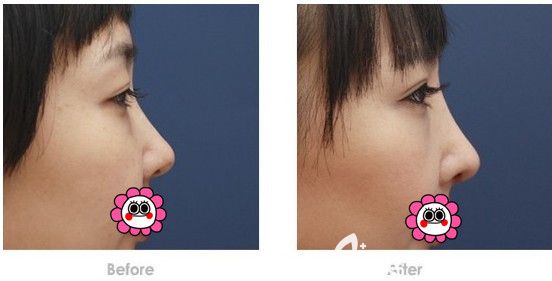 鼻子打玻尿酸对比照片图片