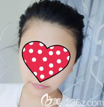 面部吸脂一个月之后的样子 面部吸脂一个月之后的样子