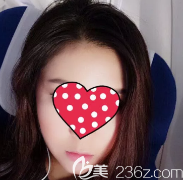 开心在德州做了面部吸脂手术，当时打肿胀液的时候真的是痛很，但是为了美我忍了