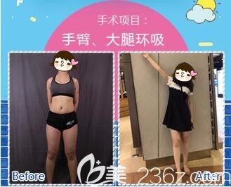 <!--<i data=20240703-sp></li>
<li><i data=20240703-sp></i>-->华美手臂+大腿环吸真人案例