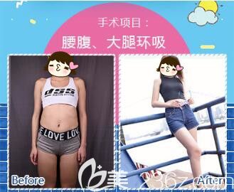 <!--<i data=20240703-sp></li>
<li><i data=20240703-sp></i>-->华美腰腹+大腿吸脂真人案例