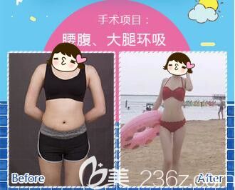 <!--<i data=20240703-sp></li>
<li><i data=20240703-sp></i>-->华美腰腹+大腿吸脂真人案例