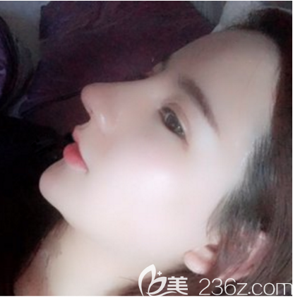 广州艺美双眼皮隆鼻修复术后7天拆线