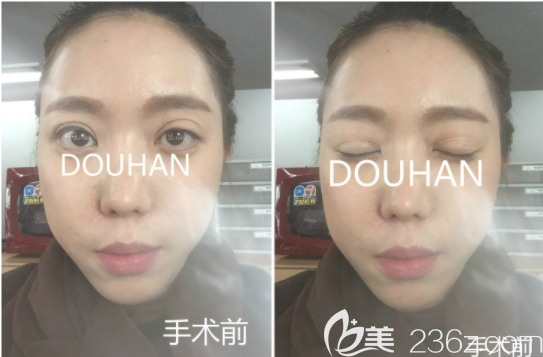 韩国枓翰整形申科翰做眼修复怎么样 韩国枓翰整形申科翰做眼修复怎么样