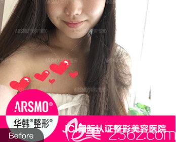 在北京华韩做曼托假体隆胸前样子 在北京华韩做曼托假体隆胸前样子