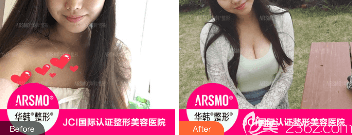 北京华韩假体隆胸前后对比图 北京华韩假体隆胸前后对比图
