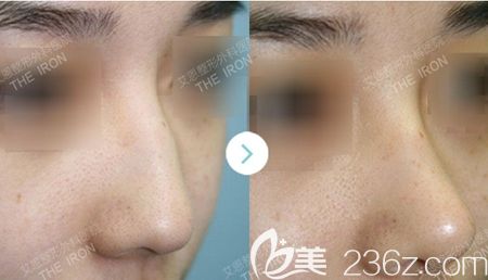 韩国艾恩鼻综合手术案例 韩国艾恩鼻综合手术案例