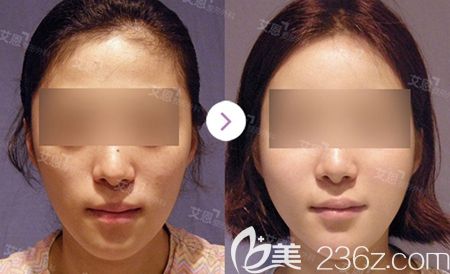 韩国艾恩全脸脂肪填充案例 韩国艾恩全脸脂肪填充案例