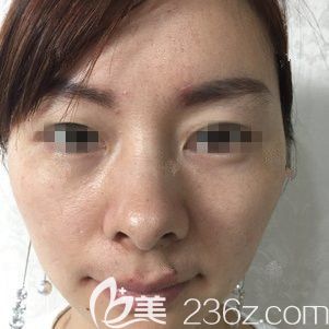 面诊徐州时光洪扬术前老态明显 面诊徐州时光洪扬术前老态明显