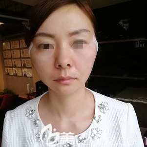 刚做完翊品铃铛线术后状态不错 刚做完翊品铃铛线术后状态不错