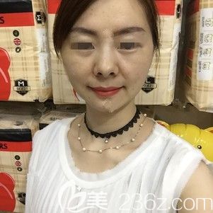 术后一周不再僵硬的翊品铃铛线效果 术后一周不再僵硬的翊品铃铛线效果