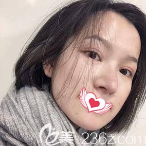 在张家口维多利亚注射玻尿酸前是大长脸 在张家口维多利亚注射玻尿酸前是大长脸