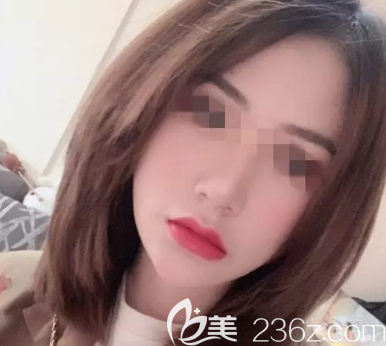 济南宝琳娜做自体脂肪填充挺好的，并且收费价格合理（附照片）