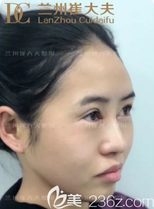 崔大夫整形小切口双眼+开眼角第1天