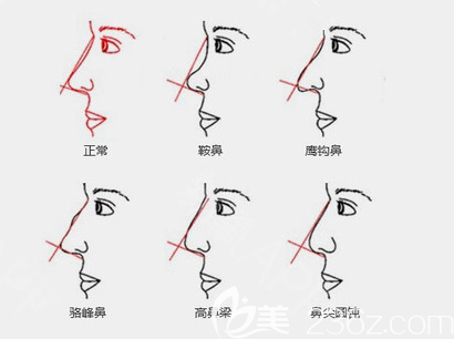 各种鼻部问题示意图 各种鼻部问题示意图