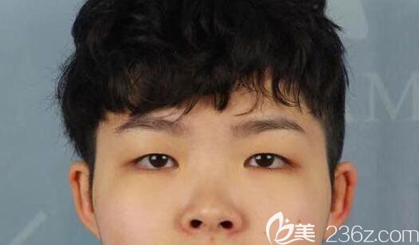 在昆明梦想隆鼻手术前 在昆明梦想隆鼻手术前