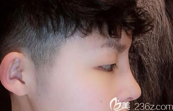 硅胶隆鼻第7天鼻子的高度是我喜欢的 硅胶隆鼻第7天鼻子的高度是我喜欢的