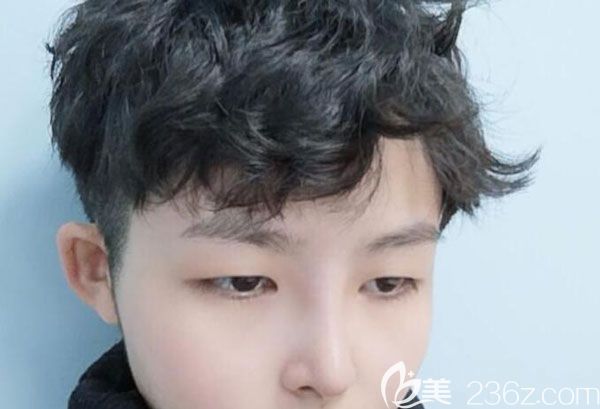 硅胶假体隆鼻第17天鼻尖精致圆润 硅胶假体隆鼻第17天鼻尖精致圆润