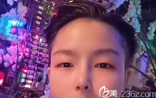 硅胶隆鼻30天鼻子基本已经定型 硅胶隆鼻30天鼻子基本已经定型