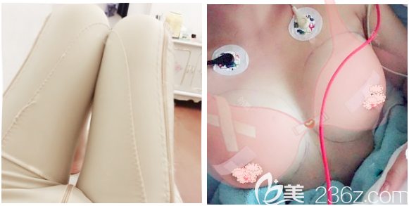 自体脂肪脂肪丰胸和大腿吸脂术后即刻效果图 自体脂肪脂肪丰胸和大腿吸脂术后即刻效果图