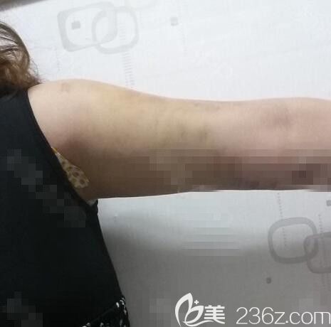 吸脂术后7天 吸脂术后7天