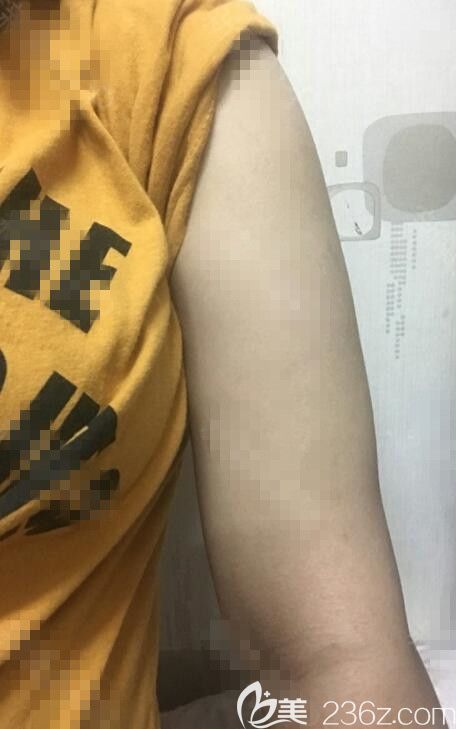 手臂吸脂术后一个月 手臂吸脂术后一个月