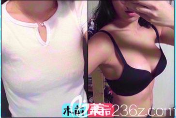 成都西区医院邓东伟假体丰胸术后对比图
