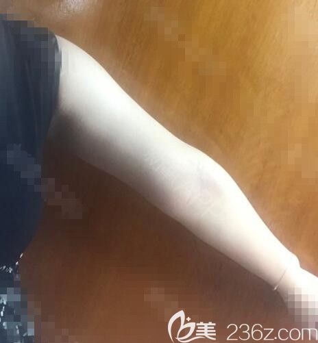 韩国劳波儿吸脂真人案例 韩国劳波儿吸脂真人案例