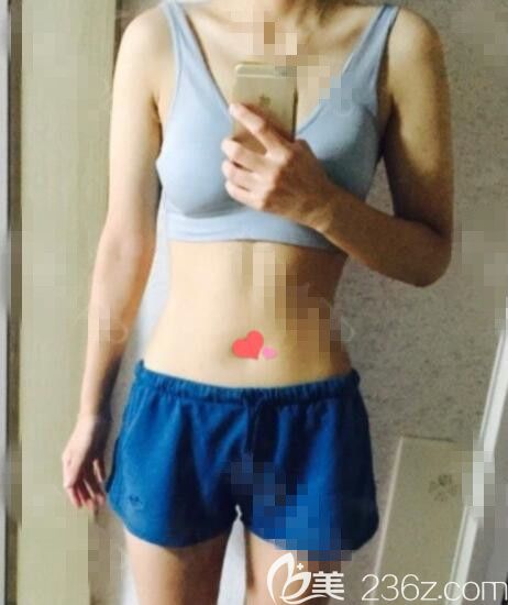 韩国ROVL劳波儿吸脂怎么样 韩国ROVL劳波儿吸脂怎么样