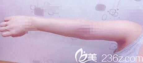 韩国ROVL劳波儿手臂吸脂案例 韩国ROVL劳波儿手臂吸脂案例