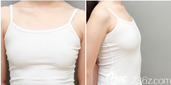 在广州天姿做隆胸手术前的样子 在广州天姿做隆胸手术前的样子