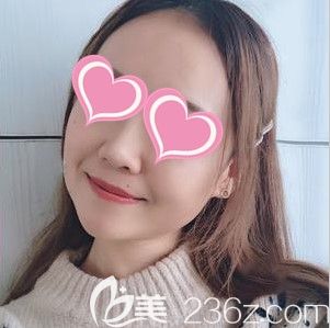 长春中妍做完瘦脸去咬肌的术后照