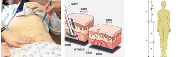 广州美莱邓劲松吸脂手术过程图 广州美莱邓劲松吸脂手术过程图