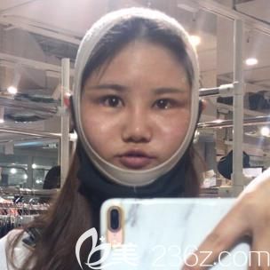韩国绮林面部轮廓整形术后1周恢复效果 韩国绮林面部轮廓整形术后1周恢复效果
