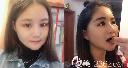 做面部轮廓术后15天真实效果图 做面部轮廓术后15天真实效果图