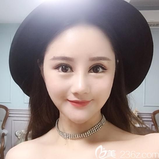 韩国面部轮廓整形案例术后半年恢复照片 韩国面部轮廓整形案例术后半年恢复照片