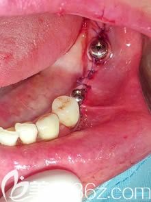 种植牙二期修复手术示意图