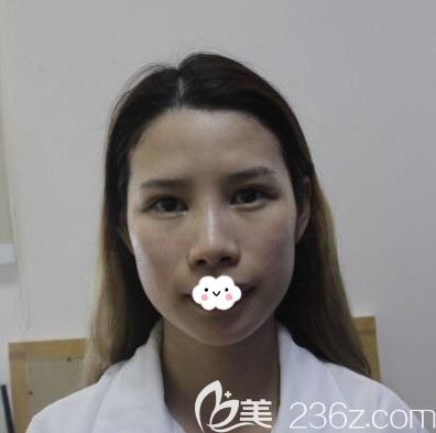 术前前下巴短小,正面侧面都不好看 术前前下巴短小,正面侧面都不好看