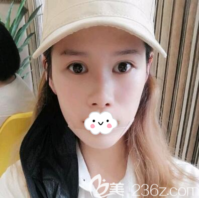 假体垫下巴术后第二天恢复照片 假体垫下巴术后第二天恢复照片