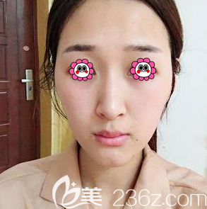 在北京艺星做硅胶假体隆鼻前样子 在北京艺星做硅胶假体隆鼻前样子