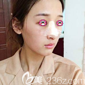 连凯峰医生给我做硅胶假体隆鼻第4天样子 连凯峰医生给我做硅胶假体隆鼻第4天样子