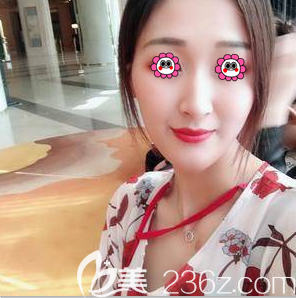 在北京艺星做硅胶假体隆鼻第36天效果 在北京艺星做硅胶假体隆鼻第36天效果