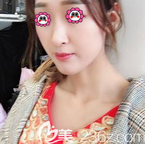 北京假体隆鼻医院排名好的北京艺星硅胶假体隆鼻案例 北京假体隆鼻医院排名好的北京艺星硅胶假体隆鼻案例