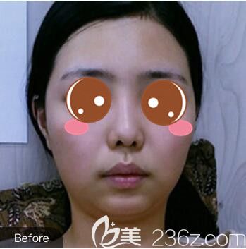 <!--<i data=20240703-sp></i>-->仁爱医院整形美容科郭新雯面部吸脂+隆鼻真人案例术前照 <!--<i data=20240703-sp></i>-->仁爱医院整形美容科郭新雯面部吸脂+隆鼻真人案例术前照
