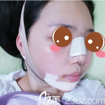 <!--<i data=20240703-sp></i>-->仁爱医院整形美容科郭新雯面部吸脂+隆鼻真人案例术后第三天 <!--<i data=20240703-sp></i>-->仁爱医院整形美容科郭新雯面部吸脂+隆鼻真人案例术后第三天