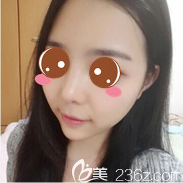 <!--<i data=20240703-sp></i>-->仁爱医院整形美容科郭新雯面部吸脂+隆鼻真人案例术后十五天 <!--<i data=20240703-sp></i>-->仁爱医院整形美容科郭新雯面部吸脂+隆鼻真人案例术后十五天