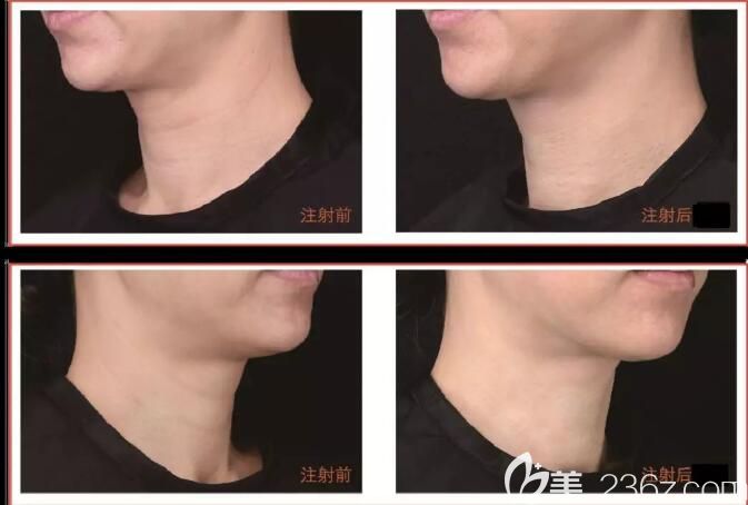 嗨体去颈纹案例对比
